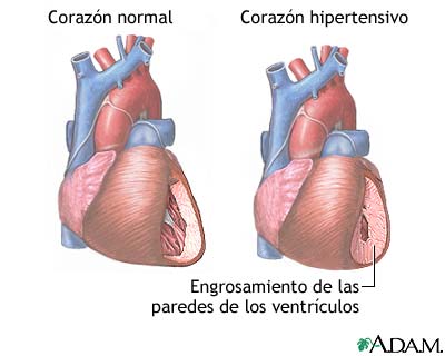 corazón con hipertensión arterial